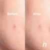 Parches Invisibles Para Granos Acne Nipskin 24 Piezas - Imagen 4